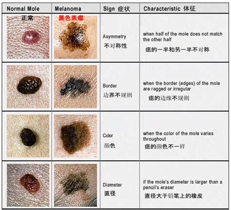 痣多的原因|痣也可能会癌变！长在 3 个地方要注意